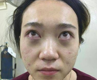 眼睛是心灵窗口,长眼袋可咋办?612 眼睛是心灵窗口,长眼袋可咋办?612