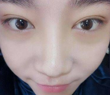 眼睛是心灵窗口,长眼袋可咋办?612 眼睛是心灵窗口,长眼袋可咋办?612