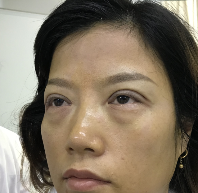 34岁才决定做眼袋,晚不晚?效果怎样?194 34岁才决定做眼袋,晚不晚?效果怎样?194