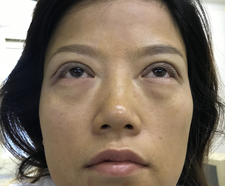 34岁才决定做眼袋,晚不晚?效果怎样?194 34岁才决定做眼袋,晚不晚?效果怎样?194