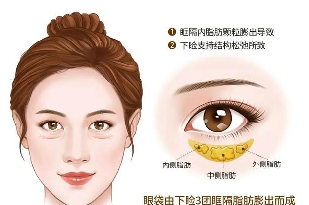 去眼袋3天能消除浮肿?真的这么快?227 去眼袋3天能消除浮肿?真的这么快?227