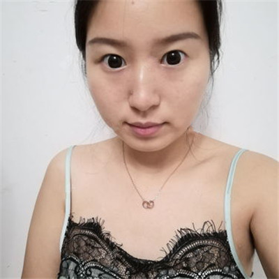 双眼皮手术