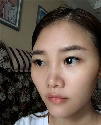 双眼皮手术