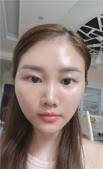 双眼皮手术