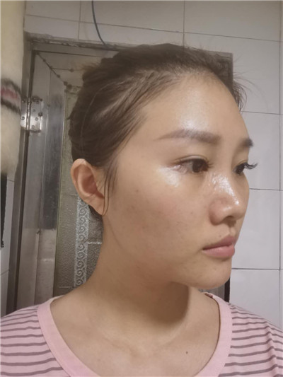双眼皮手术