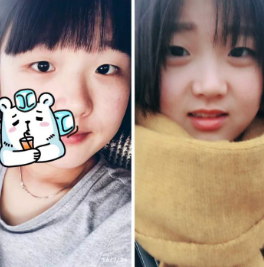 超声波复合双眼皮多久恢复自然?10天之内吗?624 超声波复合双眼皮多久恢复自然?10天之内吗?624