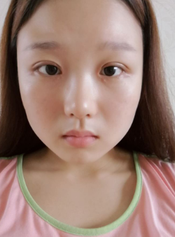 超声波复合双眼皮多久恢复自然?10天之内吗?624 超声波复合双眼皮多久恢复自然?10天之内吗?624