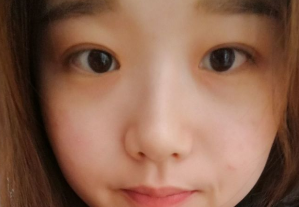 超声波复合双眼皮多久恢复自然?10天之内吗?624 超声波复合双眼皮多久恢复自然?10天之内吗?624