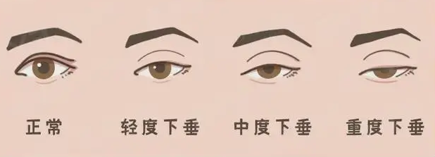 双眼皮手术