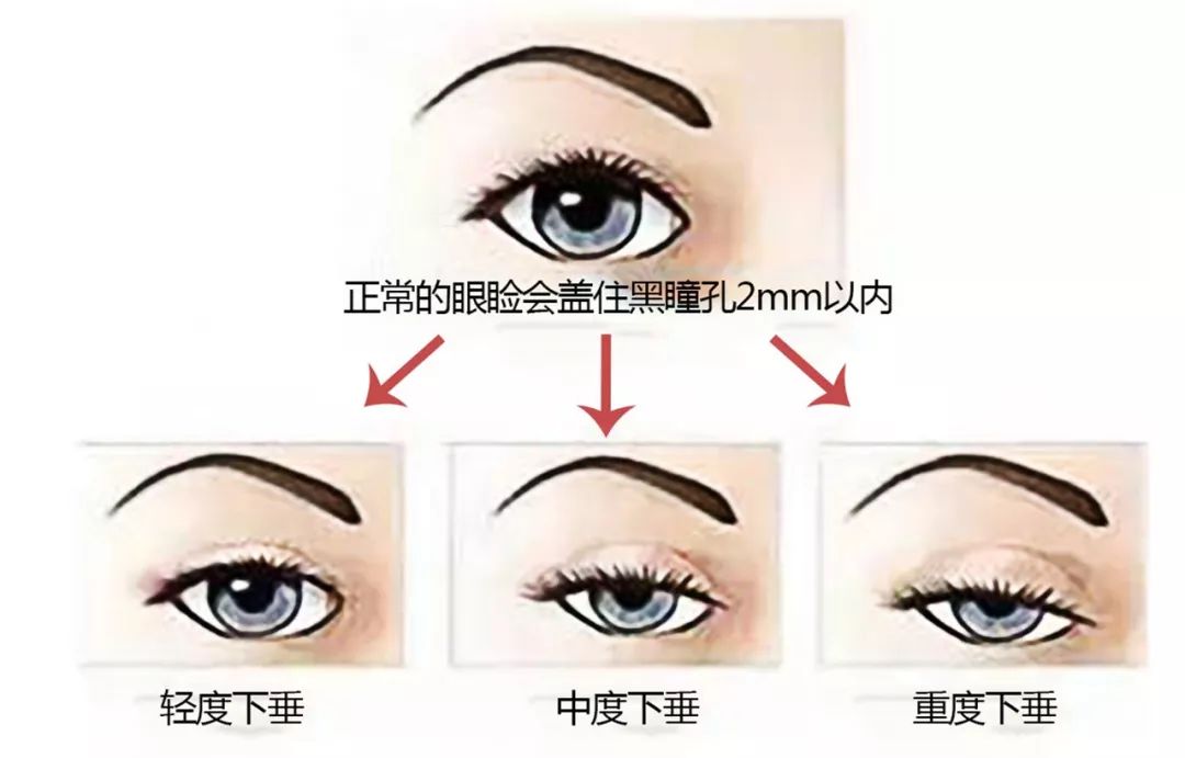 双眼皮手术