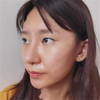 双眼皮手术