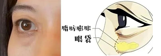 去眼袋手术