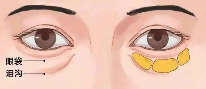 去眼袋手术