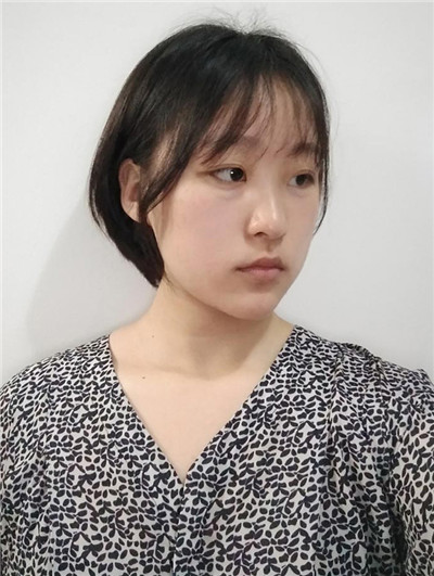 去眼袋手术的恢复多久?7天够吗?836 去眼袋手术的恢复多久?7天够吗?836