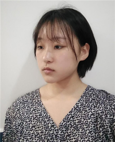 去眼袋手术的恢复多久?7天够吗?836 去眼袋手术的恢复多久?7天够吗?836
