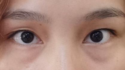 去眼袋手术