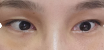 去眼袋手术