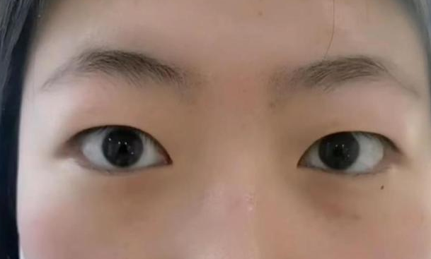 双眼皮手术