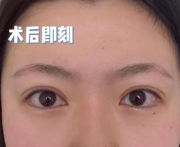 双眼皮手术