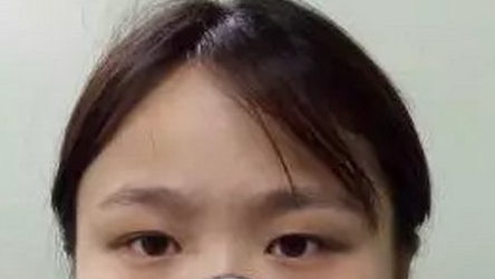 双眼皮手术