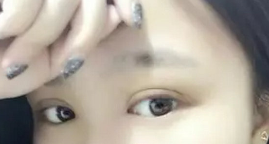 双眼皮手术