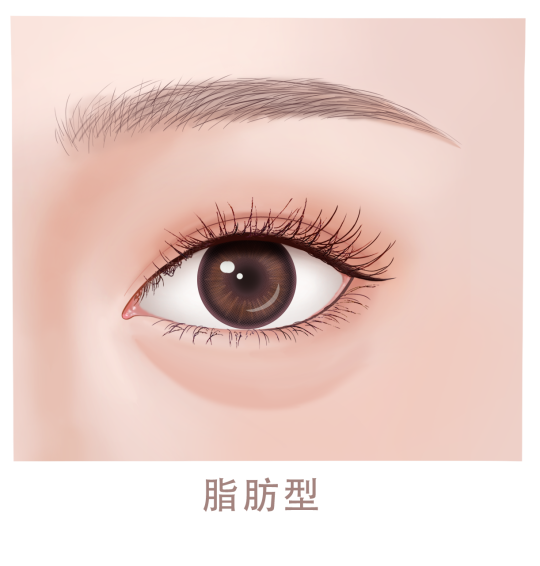 去眼袋手术