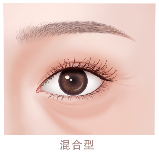去眼袋手术