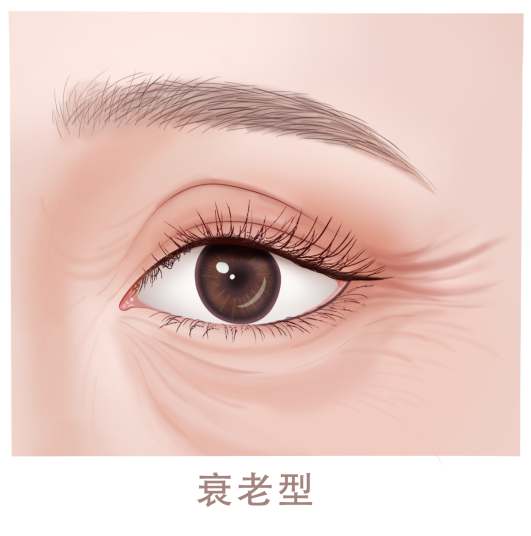 去眼袋手术