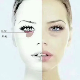 去眼袋手术
