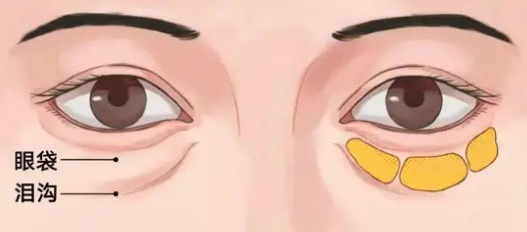 去眼袋手术