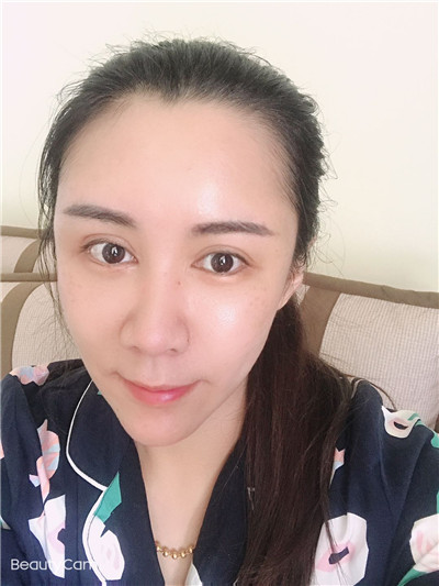 甩掉眼袋后会反弹吗?哪种去眼袋手术好?424 甩掉眼袋后会反弹吗?哪种去眼袋手术好?424