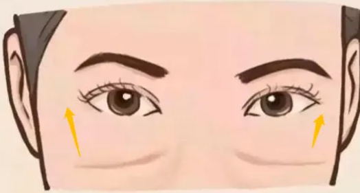 去眼袋手术