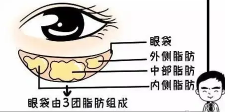 去眼袋手术