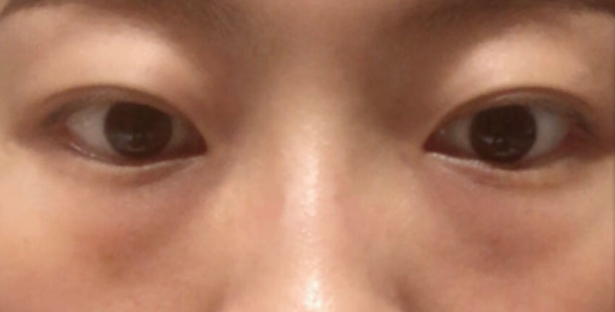 去眼袋手术