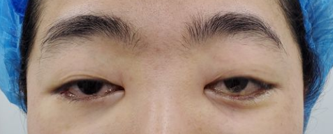 去眼袋手术