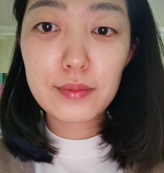 去眼袋手术