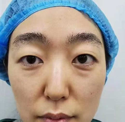 去眼袋手术