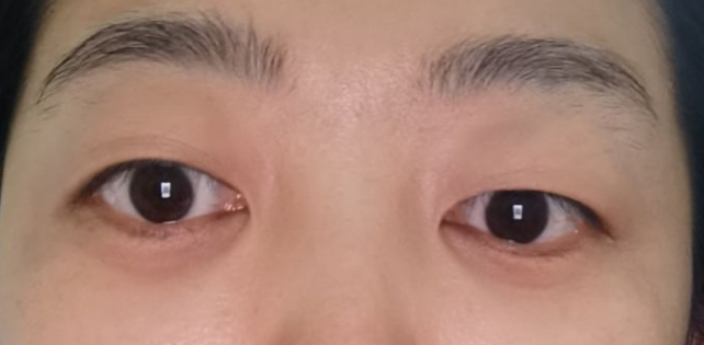 去眼袋手术