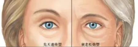 去眼袋手术