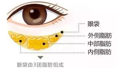去眼袋手术