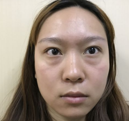 去眼袋手术