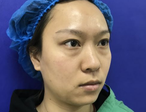 去眼袋手术