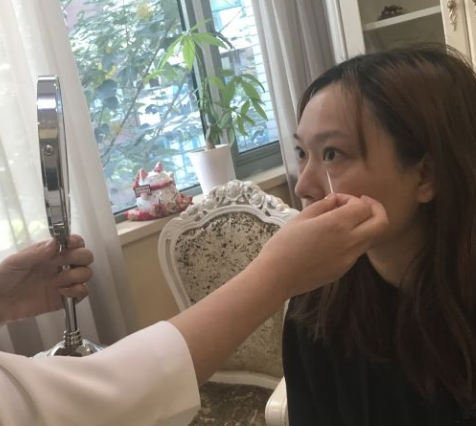 去眼袋手术