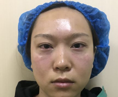 去眼袋手术