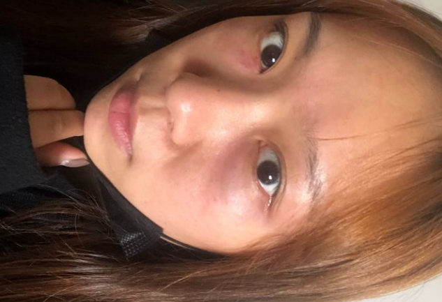 去眼袋手术