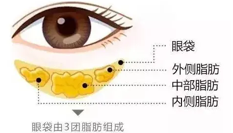 去眼袋手术