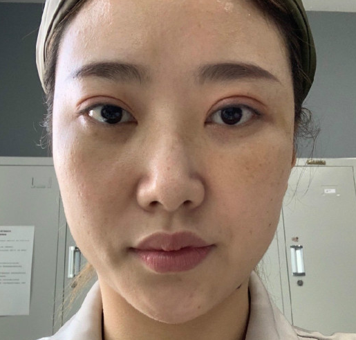 去眼袋手术