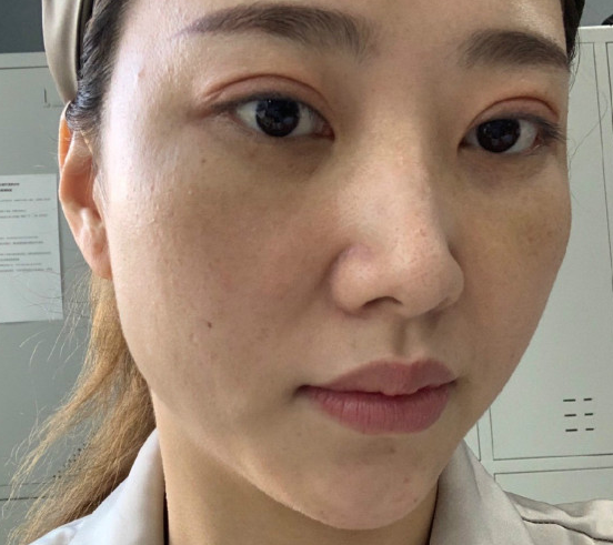 去眼袋手术