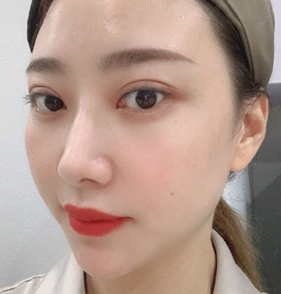 去眼袋手术