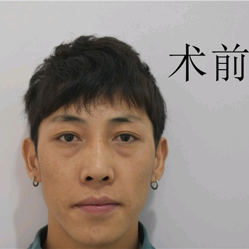 去眼袋手术